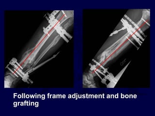 Following frame adjustment and bone
grafting
 