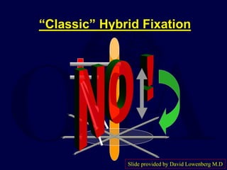 “Classic” Hybrid Fixation
Slide provided by David Lowenberg M.D
 