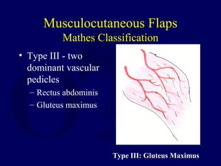 Musculocutaneous Flaps
Mathes Classification
• Type III - two
dominant vascular
pedicles
– Rectus abdominis
– Gluteus maximus
Type III: Gluteus Maximus
 