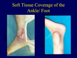 Soft Tissue Coverage of the
Ankle/ Foot
 