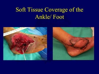Soft Tissue Coverage of the
Ankle/ Foot
 