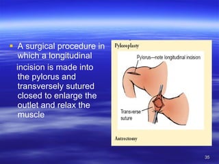 A surgical procedure in which a longitudinal incision is made into the pylorus and transversely sutured closed to enlarge the outlet and relax the muscle 
