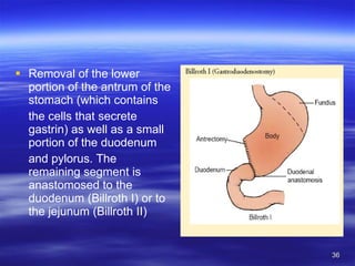 Removal of the lower portion of the antrum of the stomach (which contains the cells that secrete gastrin) as well as a small portion of the duodenum and pylorus. The remaining segment is anastomosed to the duodenum (Billroth I) or to the jejunum (Billroth II) 