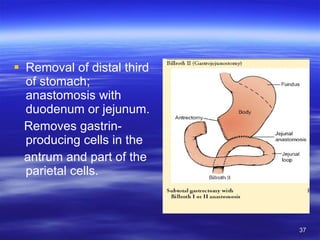 Removal of distal third of stomach; anastomosis with duodenum or jejunum. Removes gastrin-producing cells in the antrum and part of the parietal cells. 