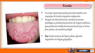 Jens Martensson 10
Erosão
• A erosão representa perda parcial do epitélio sem
exposição do tecido conjuntivo subjacente.
• Surgem em decorrência de variados processos
patológicos, predominantemente de origem sistêmica,
que produzem atrofia da mucosa bucal,que se torna
fina, plana e de aparência frágil.
• Exs.:lesões erosivas do líquen plano, glossite
migratória ou língua geográfica.
 