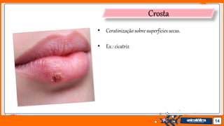 Jens Martensson 14
Crosta
• Ceratinização sobre superfícies secas.
• Ex.: cicatriz
 