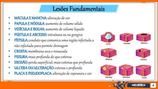 Jens Martensson 4
Lesões Fundamentais
• MÁCULAE MANCHA:alteraçãode cor
• PAPULAE NÓDULA:aumento de volume sólido
• VESÍCULAE BOLHA:aumento de volume líquido
• PÚSTULAE ABCESSO:intraóssea ou na gengiva
• FÍSTULA:conduto que comunica uma região infectada a
não infectada para permite drenagem
• CROSTA:membrana seca e ressacada
• FISSURA:mais profunda do que extensa
• EROSÃO:perda superficial; mais extensa que profunda
• ULCERAOUULCERAÇÃO:extensa e profunda
• PLACAE PSEUDOPLACA:alteraçãode espessura e cor
 