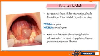 Jens Martensson 6
Pápula e Nódulo
• São pequenas lesões sólidas, circunscritas, elevadas
formados por tecido epitelial, conjuntivo ou misto
PÁPULA:até 5 mm
NÓDULO:acima de 5 mm
• Exs.:lesões de tumores glandulares(glândulas
salivares maiores ou menores), papilomas, lipomas,
granulomas piogênicos, fibromas.
 