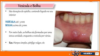 Jens Martensson 7
Vesícula e Bolha
• São elevações do epitélio, contendo líquido no seu
interior
VESÍCULA:até 5 mm
BOLHA:acima de 5 mm
• Por outro lado, as bolhas são formadas por uma
única cavidade, enquanto a vesícula por várias.
• Exs.:Herpes simples, pênfigo vulgar, etc
 