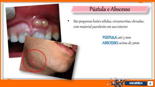 Jens Martensson 8
Pústula e Abscesso
• São pequenas lesões sólidas, circunscritas, elevadas,
com material purulento em seu interior
PÚSTULA:até 5 mm
ABSCESSO:acima de 5mm
 