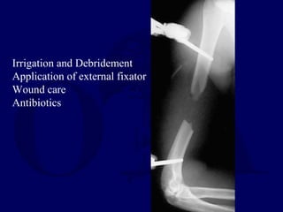 Irrigation and Debridement
Application of external fixator
Wound care
Antibiotics
 