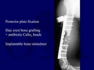 Posterior plate fixation
Iliac crest bone grafting
+ antibiotic CaSo4 beads
Implantable bone stimulator
 
