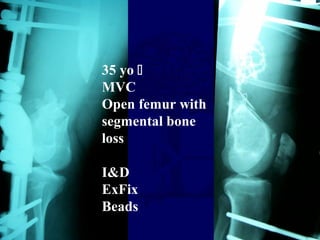 35 yo 
MVC
Open femur with
segmental bone
loss
I&D
ExFix
Beads
 