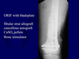 ORIF with bladeplate
fibular strut allograft
cancellous autograft
CaSO4 pellets
Bone stimulator
 