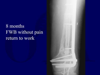 8 months
FWB without pain
return to work
 