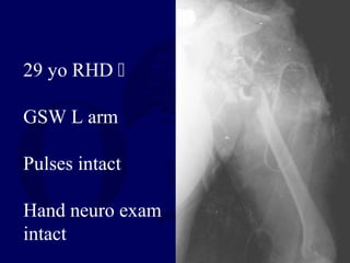 29 yo RHD 
GSW L arm
Pulses intact
Hand neuro exam
intact
 