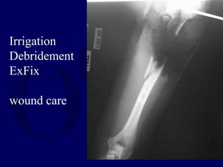 Irrigation
Debridement
ExFix
wound care
 