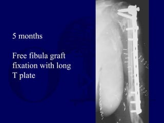 5 months
Free fibula graft
fixation with long
T plate
 