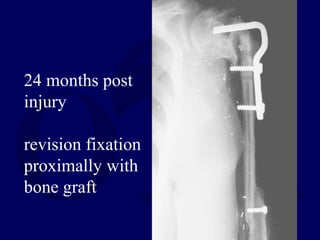 24 months post
injury
revision fixation
proximally with
bone graft
 