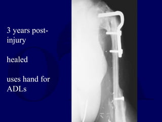 3 years post-
injury
healed
uses hand for
ADLs
 