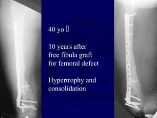 40 yo 
10 years after
free fibula graft
for femoral defect
Hypertrophy and
consolidation
 