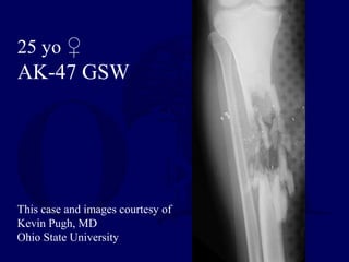 25 yo ♀
AK-47 GSW
This case and images courtesy of
Kevin Pugh, MD
Ohio State University
 