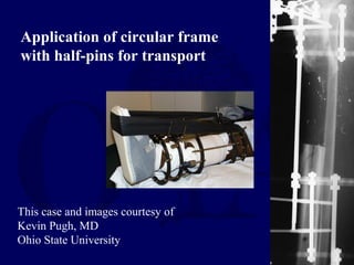 This case and images courtesy of
Kevin Pugh, MD
Ohio State University
Application of circular frame
with half-pins for transport
 