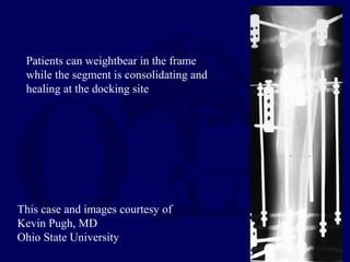 This case and images courtesy of
Kevin Pugh, MD
Ohio State University
Patients can weightbear in the frame
while the segment is consolidating and
healing at the docking site
 