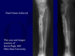 This case and images
courtesy of
Kevin Pugh, MD
Ohio State University
Final Union Achieved
 