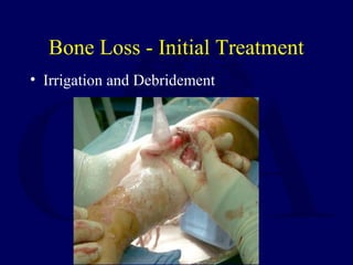 Bone Loss - Initial Treatment
• Irrigation and Debridement
 