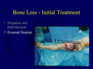 Bone Loss - Initial Treatment
• Irrigation and
Debridement
• External fixation
 