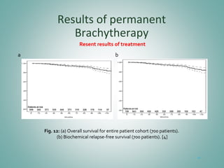 Results of permanent
Brachytherapy
Resent results of treatment
43
Fig. 12: (a) Overall survival for entire patient cohort (700 patients).
(b) Biochemical relapse-free survival (700 patients). [4]
a b
 