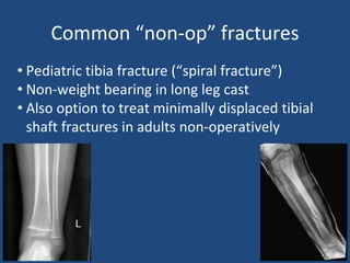Common “non-op” fractures
• Pediatric tibia fracture (“spiral fracture”)
• Non-weight bearing in long leg cast
• Also option to treat minimally displaced tibial
shaft fractures in adults non-operatively
 