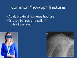 Common “non-op” fractures
• Adult proximal humerus fracture
• Treated in “cuff and collar”
• Gravity assisted
 