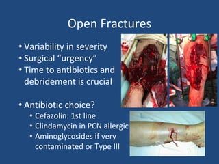 Open Fractures
• Variability in severity
• Surgical “urgency”
• Time to antibiotics and
debridement is crucial
• Antibiotic choice?
• Cefazolin: 1st line
• Clindamycin in PCN allergic
• Aminoglycosides if very
contaminated or Type III
 