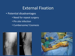 External Fixation
• Potential disadvantages
• Need for repeat surgery
• Pin site infection
• Cumbersome/ Cosmesis
 