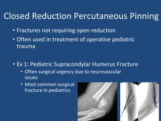 Closed Reduction Percutaneous Pinning
• Fractures not requiring open reduction
• Often used in treatment of operative pediatric
trauma
• Ex 1: Pediatric Supracondylar Humerus Fracture
• Often surgical urgency due to neurovascular
issues
• Most common surgical
fracture in pediatrics
 
