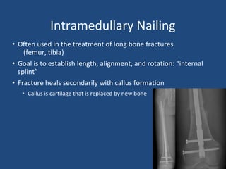 Intramedullary Nailing
• Often used in the treatment of long bone fractures
(femur, tibia)
• Goal is to establish length, alignment, and rotation: “internal
splint”
• Fracture heals secondarily with callus formation
• Callus is cartilage that is replaced by new bone
 