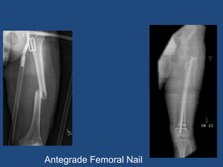 Antegrade Femoral Nail
 