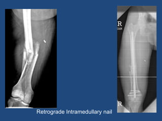 Retrograde Intramedullary nail
 