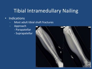 Tibial Intramedullary Nailing
• Indications
- Most adult tibial shaft fractures
- Approach
- Parapatellar
- Suprapatellar
 
