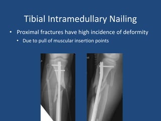 Tibial Intramedullary Nailing
• Proximal fractures have high incidence of deformity
• Due to pull of muscular insertion points
 