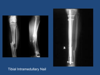 Tibial Intramedullary Nail
 