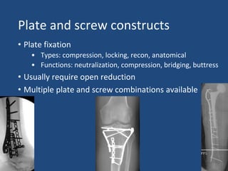 Plate and screw constructs
• Plate fixation
• Types: compression, locking, recon, anatomical
• Functions: neutralization, compression, bridging, buttress
• Usually require open reduction
• Multiple plate and screw combinations available
 