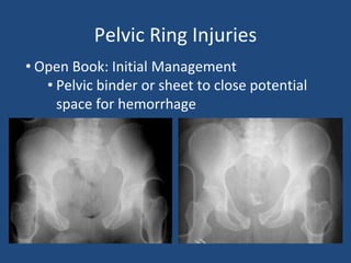 Pelvic Ring Injuries
• Open Book: Initial Management
• Pelvic binder or sheet to close potential
space for hemorrhage
 
