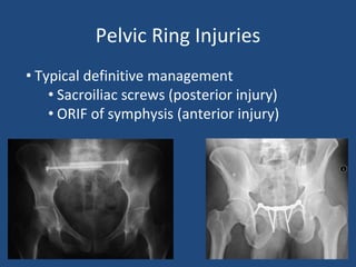 Pelvic Ring Injuries
• Typical definitive management
• Sacroiliac screws (posterior injury)
• ORIF of symphysis (anterior injury)
 