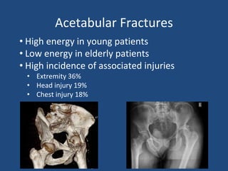 Acetabular Fractures
• High energy in young patients
• Low energy in elderly patients
• High incidence of associated injuries
• Extremity 36%
• Head injury 19%
• Chest injury 18%
 