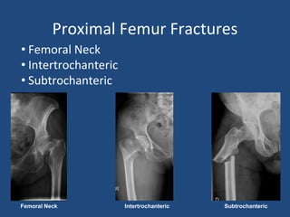 Proximal Femur Fractures
• Femoral Neck
• Intertrochanteric
• Subtrochanteric
Femoral Neck Intertrochanteric Subtrochanteric
 