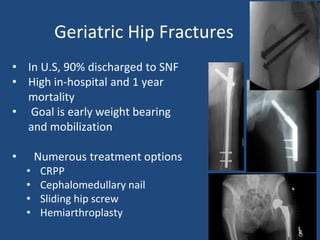 Geriatric Hip Fractures
• In U.S, 90% discharged to SNF
• High in-hospital and 1 year
mortality
• Goal is early weight bearing
and mobilization
• Numerous treatment options
• CRPP
• Cephalomedullary nail
• Sliding hip screw
• Hemiarthroplasty
 