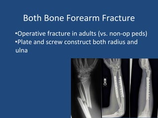 Both Bone Forearm Fracture
•Operative fracture in adults (vs. non-op peds)
•Plate and screw construct both radius and
ulna
 